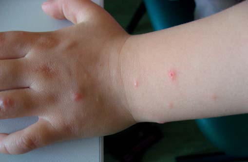 virus with rash #10